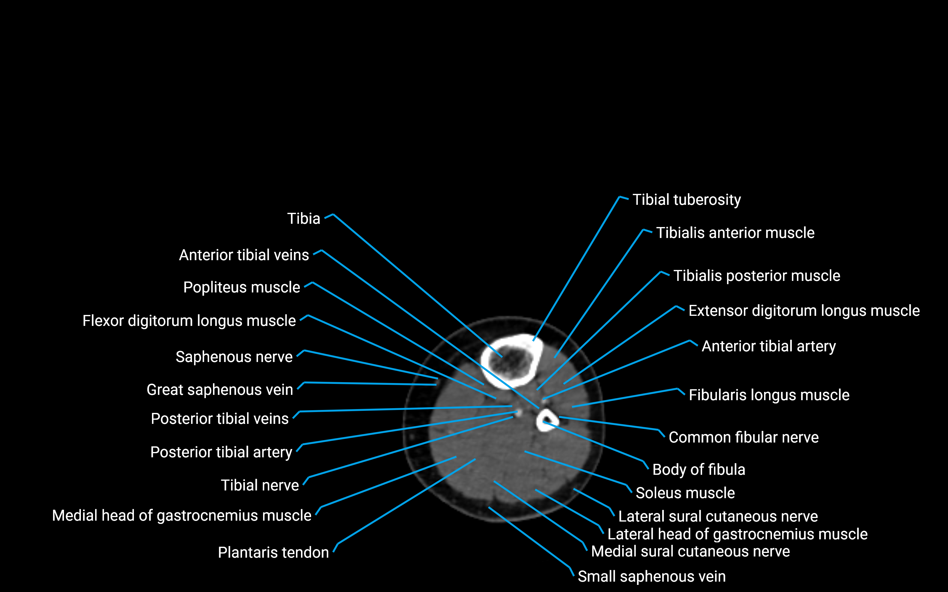 CT Lower leg axial cross sectional anatomy labelled image 103 (2).png